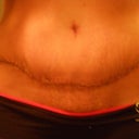 4 weeks post op. Is this normal looking???