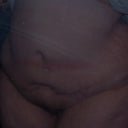 This is 14 months after surgery. The doc told me that he would repair this after it healed, then, he wanted me to pay MORE money to go to the OR to fix it.  It doesn't bother me or my husband, so we decided not to worry about it. 
