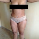 2 days post op