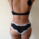 18 days post op