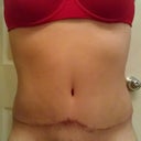Post Op week 12
At 3 months post op I am still very happy! There is a very slight bulge on my left side incision (by the doorknob in pic) that sticks out. I don't think it's a dog ear but I'll bring it up to my PS