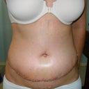 one week post surgery