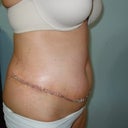 one week post surgery