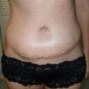 2 months post surgery, still very swollen