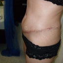 2 months post surgery, very swollen