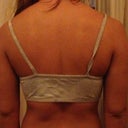 12 days post op back