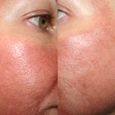 Day after Fraxel #3. Swollen sandpaper skin :).