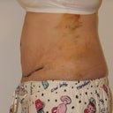Left Side View - 9 days post op