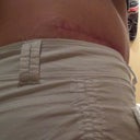 6 Months Post-op right side. Scar shows above pant line - Praying it turns white soon