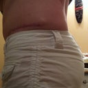6 months post-op left side