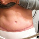 6 months post-op. front veiw still very high hoping the lipo drops it. I think its fading but I'm noticing that it also has a streched out look to it like a strech mark :(