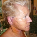 2 days after surgery...some swelling but visible improvement already