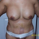5 days post-op tummy and breast