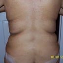 5 days post-op back