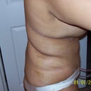 5 days post-op side view