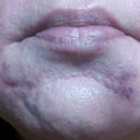 One day post injection