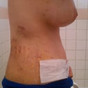 week 1 post-op