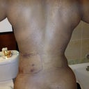 Post Procedure (Back)