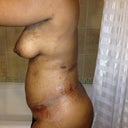 Post Procedure (Side)