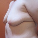 Pre Op