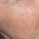 This is my face before IPL had brown spots and crows feet. No lines on my cheeks