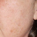 This is after a chemical peel in August of 2011. Made brown spots a little lighter.