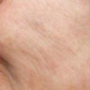 This is in Oct. 2011 about two weeks after the second IPL visit. Notice the indents,enlarged pores. I still have crows feet and they are even worse along with lines all over my face I did not have before
