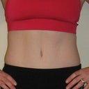 11 months out from surgery