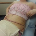 At the Dr. Post op Day 5