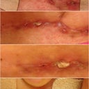 Spitting Stitches.  I don't remember when the 1st pic was taken, but you can see it stitch starting to eject.  The last 3 pics are day 45.  I started to mess with it more & after the dried scabby stuff came off you can see the stitches clear as day.