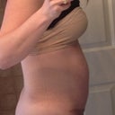 6 weeks post op, worst its looked so far. I called my PS in a panic after this.