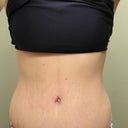 7 Weeks Post op