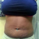 Front 2weeks post op Now to rid of these "tell everyone im fat" marks