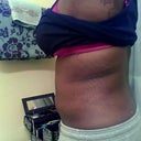 Side view 2 weeks Post op More Strecth Marks lol