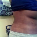 ha ha you can see my little marks but back view 2weeks post op