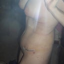 side view...very swollen above incision