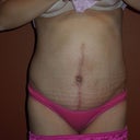 5 weeks PO, wearing low cut underwear and I see that my side aren't very symmetrical :o(