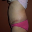 5 weeks PO, My hematoma is improving (that protruding area above my bellybutton).  You can also see the swelling in my lower abdomen by my incision (or at least I hope it is swelling and not loose skin).