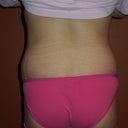 5 weeks PO, you can see my love handles that stick out when I wear low-cut underwear.  This is probably what bothers me the most.