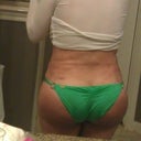 18 DAYS POST OP