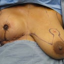 This is an intraoperative pic, one breast reduced, the other with preop markings ready to be reduced!  Im not sure how much tissue was actually removed but I am considerably smaller now! Freedom Finally!