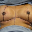 Heres my new breast, or "newbies" as my husband has affectionately called them!  Note the drains...they are necessary (Ive had lots of fluid drain from them and I feel if they werent there it would have been so much more uncomfortable for me with engourged breast) but they are the second least favorite part of my recovery right now!