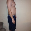 One week before smart lipo. Right side.