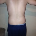 One week before smart lipo. Back pic.