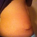 03/15/2012 almost 5 months sideways (night time... note the swelling above bb and it also happens above incision)