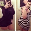 3 1/2  months post BBL.