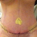 Day 3 post op. Loving my scar!
