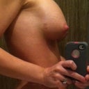 3 weeks post op