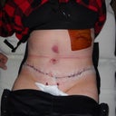 Post op day one