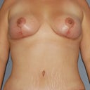 After: 5 weeks, front view.  End of the day, tons of swelling above incision and on right hip.